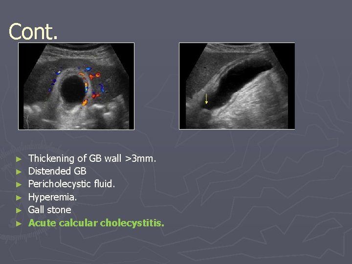 Cont. ► ► ► Thickening of GB wall >3 mm. Distended GB Pericholecystic fluid.