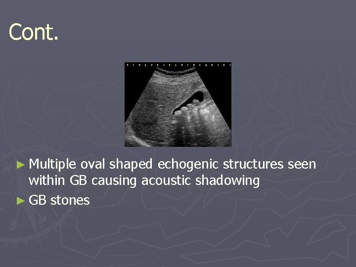 Cont. ► Multiple oval shaped echogenic structures seen within GB causing acoustic shadowing ►