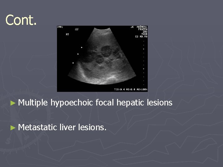 Cont. ► Multiple hypoechoic focal hepatic lesions ► Metastatic liver lesions. 