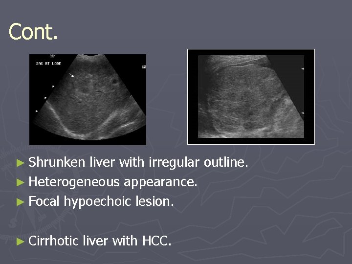 Cont. ► Shrunken liver with irregular outline. ► Heterogeneous appearance. ► Focal hypoechoic lesion.