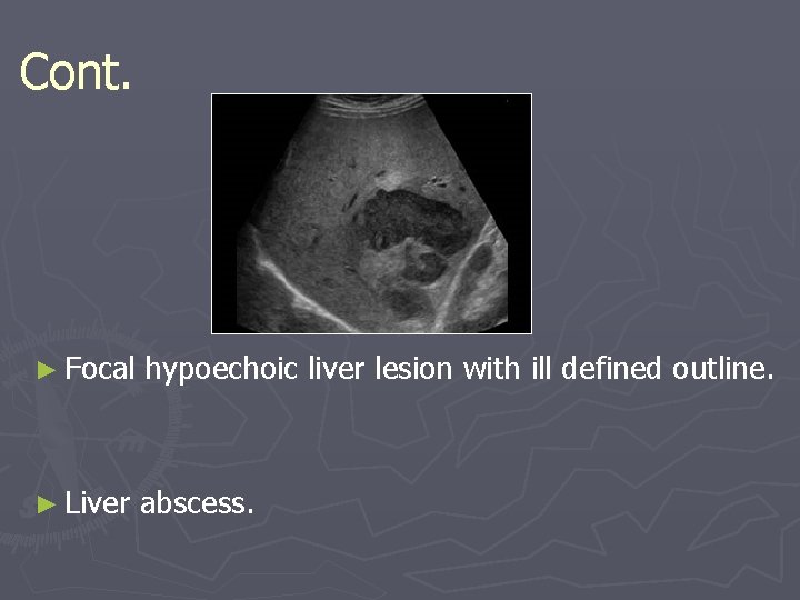 Cont. ► Focal hypoechoic liver lesion with ill defined outline. ► Liver abscess. 