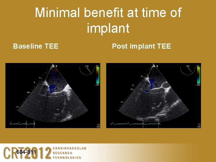 Minimal benefit at time of implant Baseline TEE 604 -011 Post implant TEE 