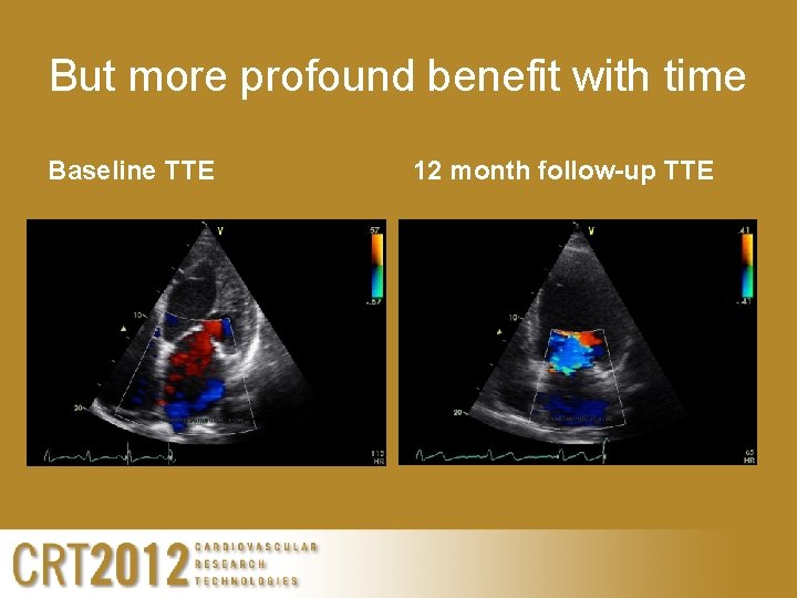 But more profound benefit with time Baseline TTE 12 month follow-up TTE 