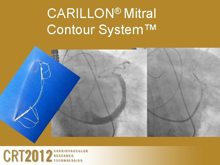 CARILLON® Mitral Contour System™ 