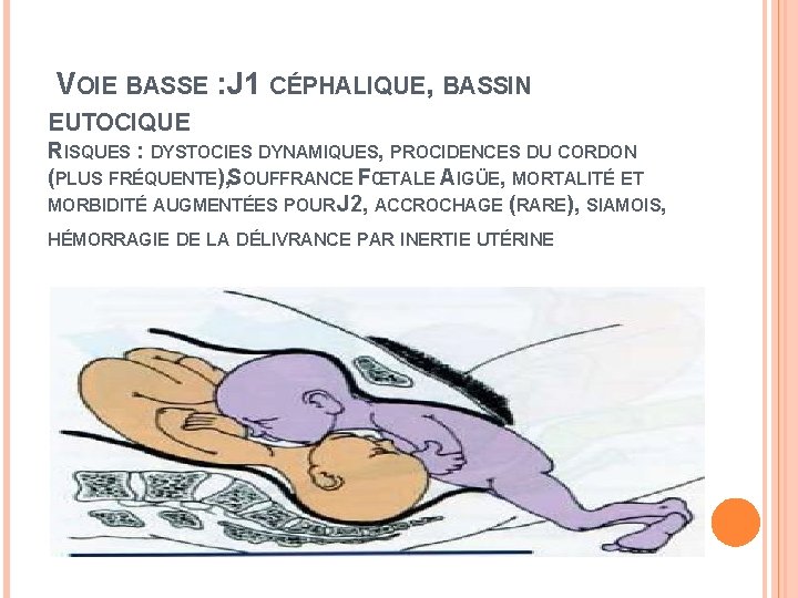 VOIE BASSE : J 1 CÉPHALIQUE, BASSIN EUTOCIQUE RISQUES : DYSTOCIES DYNAMIQUES, PROCIDENCES DU