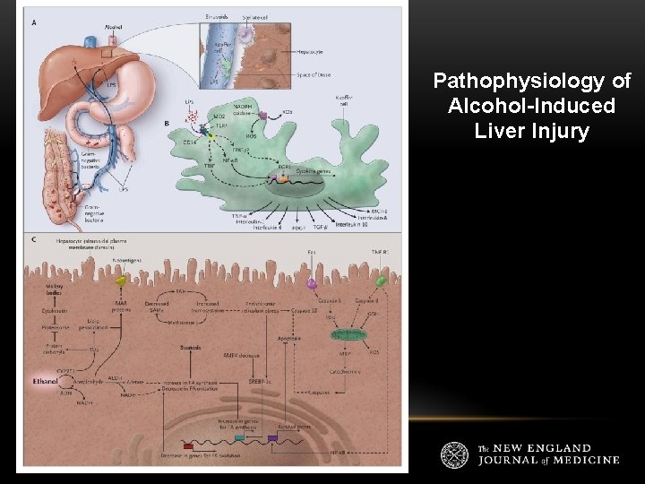 Pathophysiology of Alcohol-Induced Liver Injury 