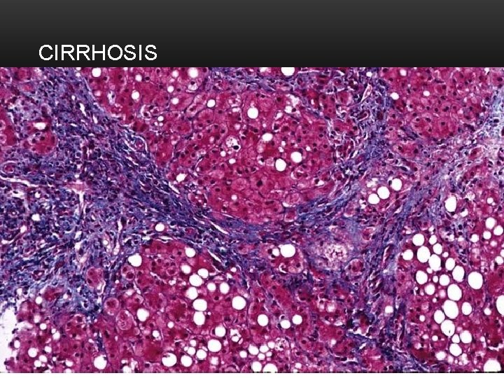 CIRRHOSIS 