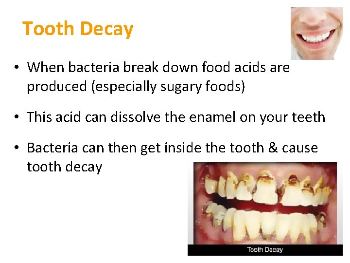 Tooth Decay • When bacteria break down food acids are produced (especially sugary foods) Tooth Decay • When bacteria break down food acids are produced (especially sugary foods)