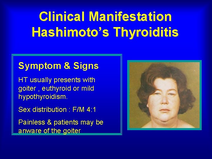 Clinical Manifestation Hashimoto’s Thyroiditis Symptom & Signs HT usually presents with goiter , euthyroid