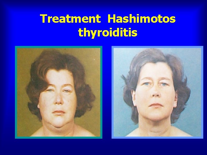 Treatment Hashimotos thyroiditis 