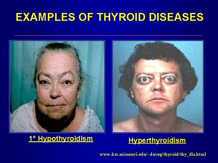 EXAMPLES OF THYROID DISEASES 1° Hypothyroidism Hyperthyroidism www. hsc. missouri. edu/~daveg/thyroid/thy_dis. html 