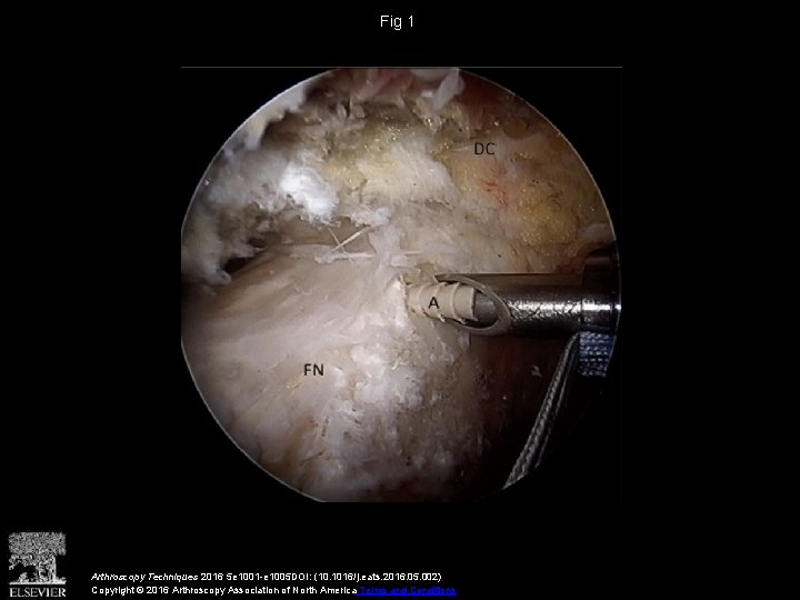 Fig 1 Arthroscopy Techniques 2016 5 e 1001 -e 1005 DOI: (10. 1016/j. eats.