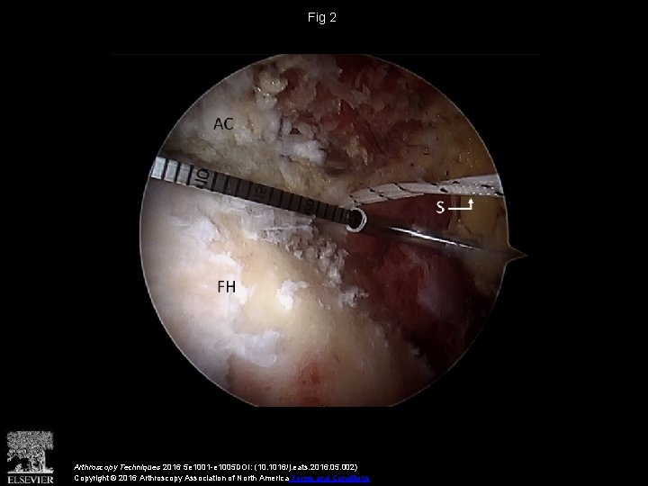 Fig 2 Arthroscopy Techniques 2016 5 e 1001 -e 1005 DOI: (10. 1016/j. eats.