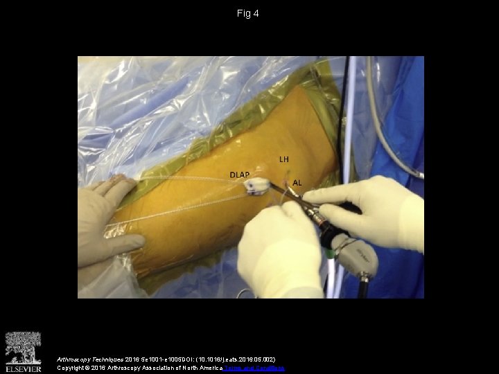 Fig 4 Arthroscopy Techniques 2016 5 e 1001 -e 1005 DOI: (10. 1016/j. eats.