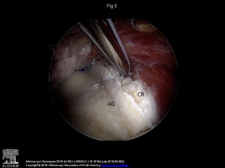 Fig 5 Arthroscopy Techniques 2016 5 e 1001 -e 1005 DOI: (10. 1016/j. eats.