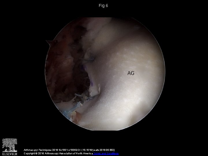 Fig 6 Arthroscopy Techniques 2016 5 e 1001 -e 1005 DOI: (10. 1016/j. eats.