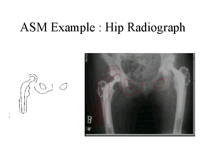 ASM Example : Hip Radiograph ASM Example : Hip Radiograph