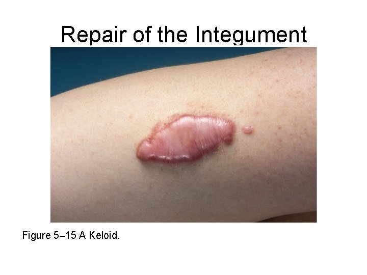 Repair of the Integument Figure 5– 15 A Keloid. 
