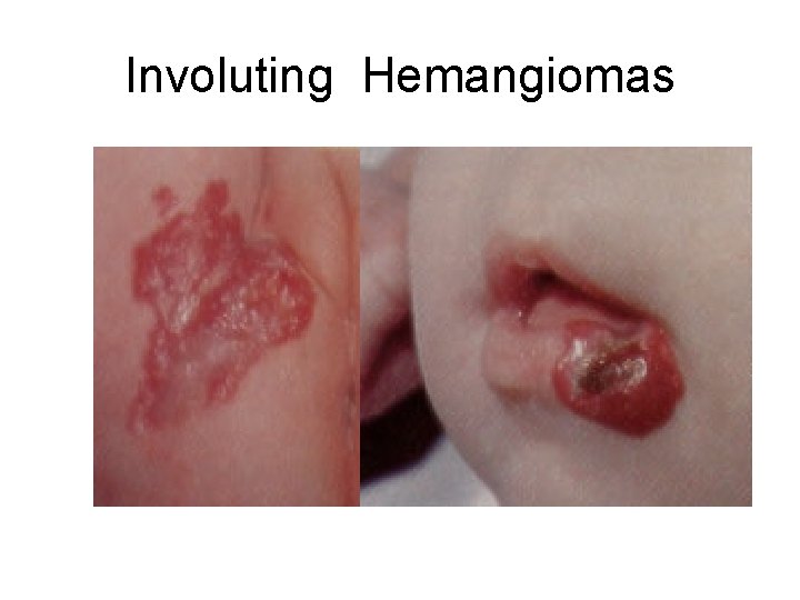 Involuting Hemangiomas 