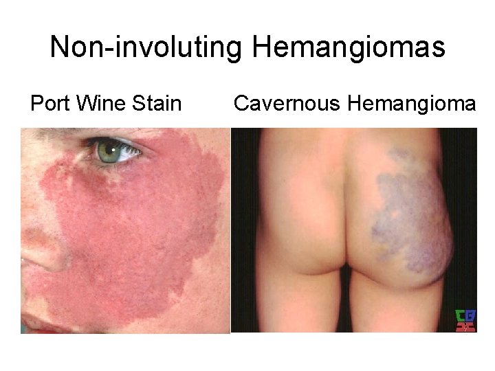 Non-involuting Hemangiomas Port Wine Stain Cavernous Hemangioma 