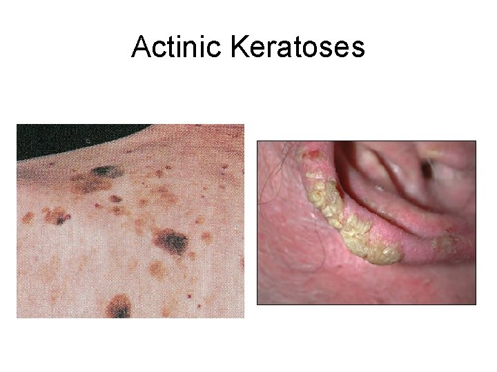 Actinic Keratoses 