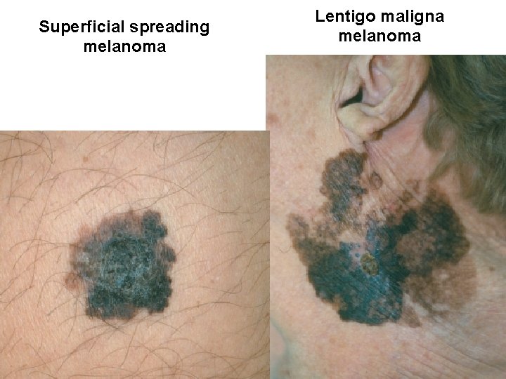 Superficial spreading melanoma Lentigo maligna melanoma 