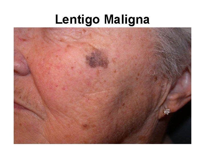 Lentigo Maligna 