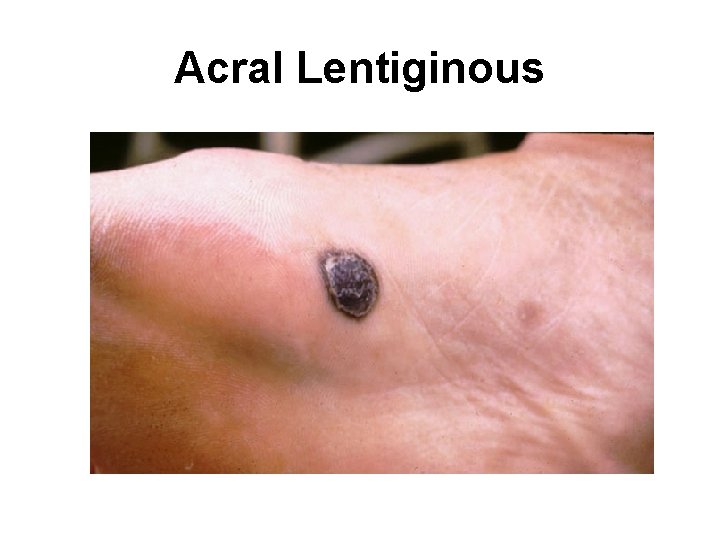 Acral Lentiginous 
