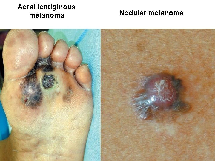 Acral lentiginous melanoma Nodular melanoma 