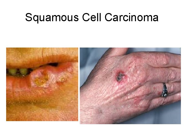 Squamous Cell Carcinoma 