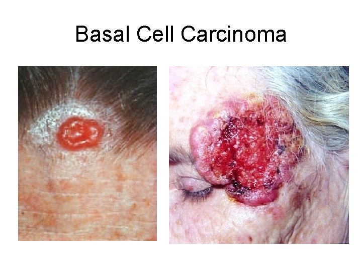 Basal Cell Carcinoma 