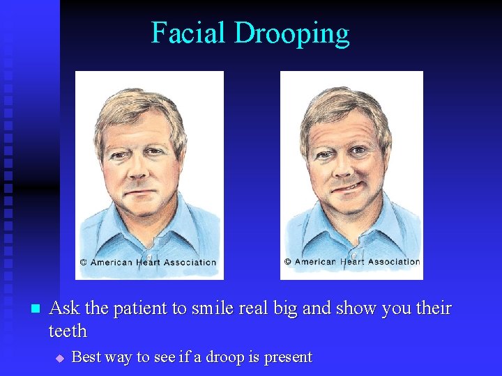 Facial Drooping n Ask the patient to smile real big and show you their Facial Drooping n Ask the patient to smile real big and show you their