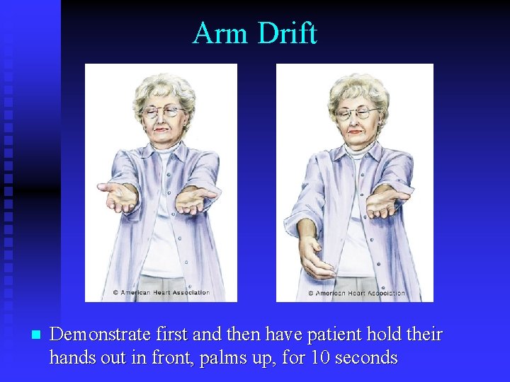 Arm Drift n Demonstrate first and then have patient hold their hands out in Arm Drift n Demonstrate first and then have patient hold their hands out in