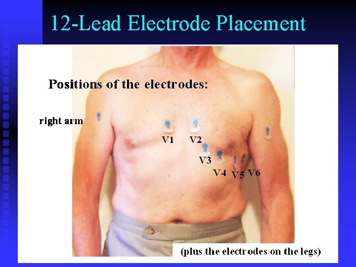 12 -Lead Electrode Placement 12 -Lead Electrode Placement