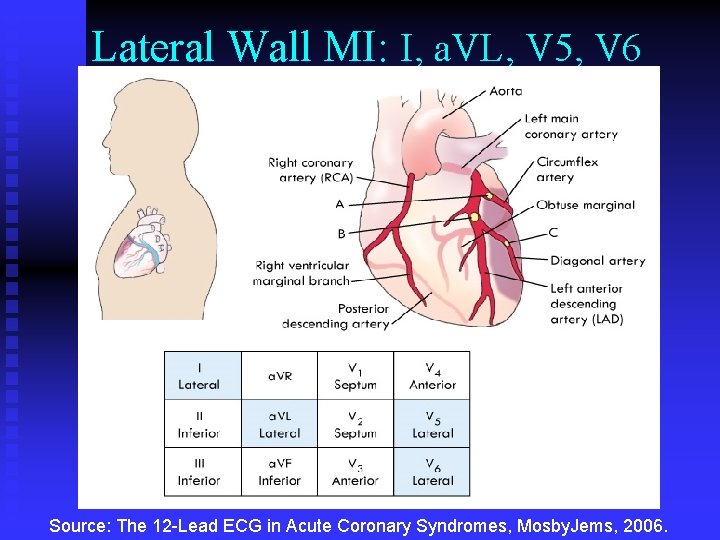 Lateral Wall MI: I, a. VL, V 5, V 6 Source: The 12 -Lead Lateral Wall MI: I, a. VL, V 5, V 6 Source: The 12 -Lead