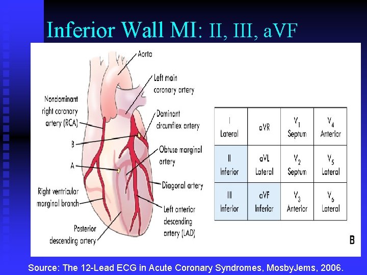 Inferior Wall MI: II, III, a. VF Source: The 12 -Lead ECG in Acute Inferior Wall MI: II, III, a. VF Source: The 12 -Lead ECG in Acute