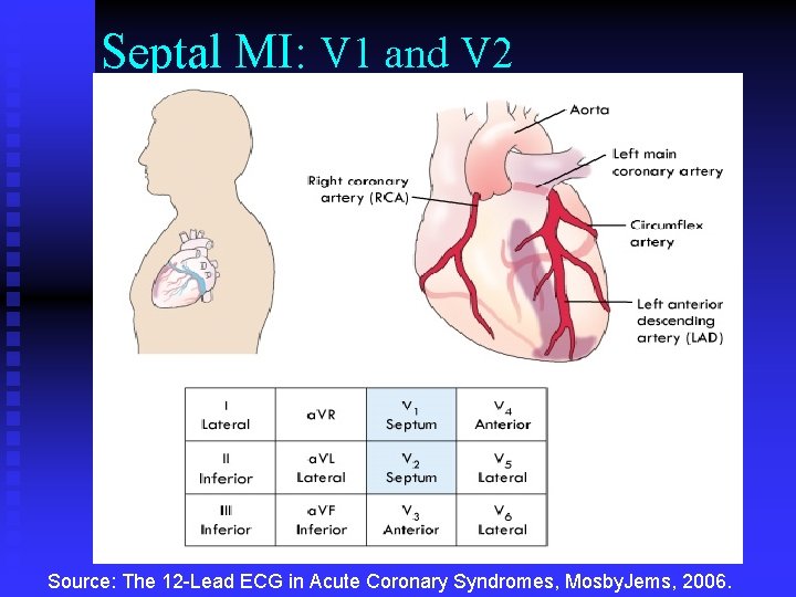 Septal MI: V 1 and V 2 Source: The 12 -Lead ECG in Acute Septal MI: V 1 and V 2 Source: The 12 -Lead ECG in Acute