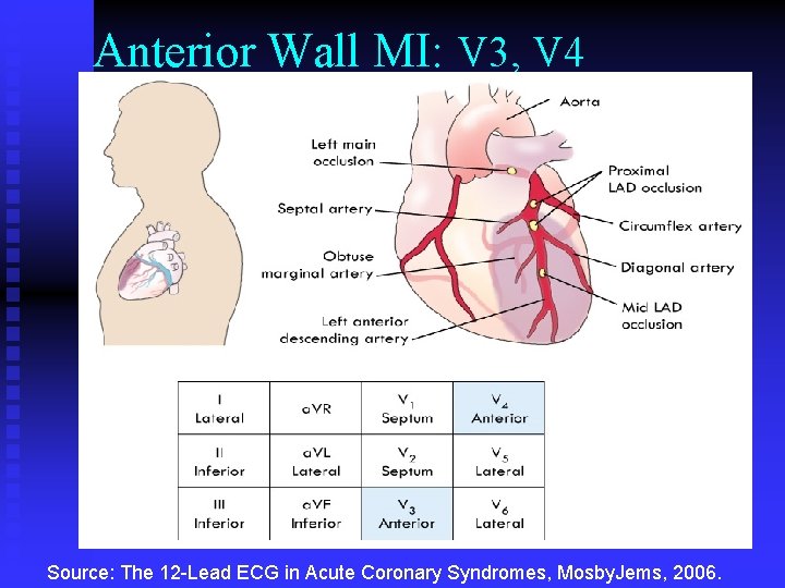 Anterior Wall MI: V 3, V 4 Source: The 12 -Lead ECG in Acute Anterior Wall MI: V 3, V 4 Source: The 12 -Lead ECG in Acute