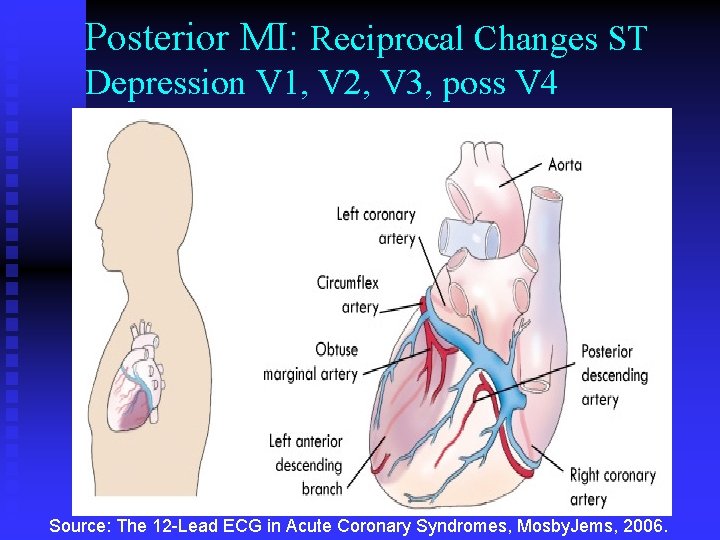 Posterior MI: Reciprocal Changes ST Depression V 1, V 2, V 3, poss V Posterior MI: Reciprocal Changes ST Depression V 1, V 2, V 3, poss V