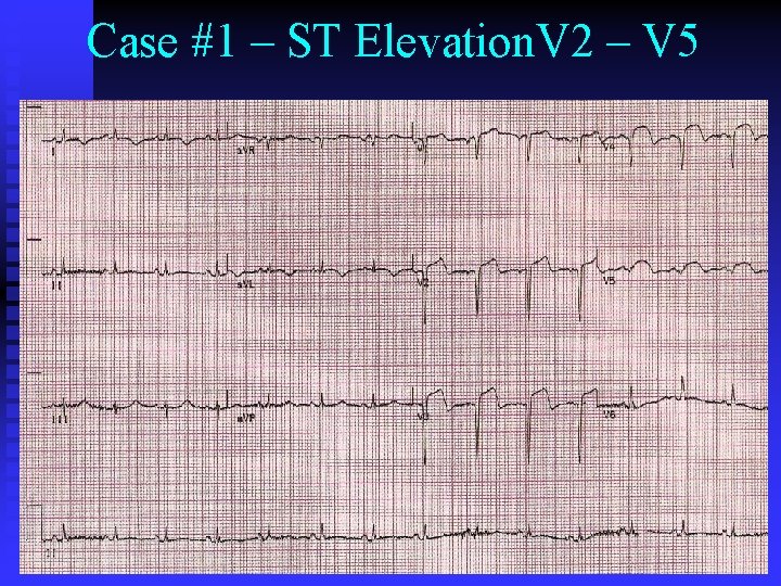 Case #1 – ST Elevation. V 2 – V 5 Case #1 – ST Elevation. V 2 – V 5