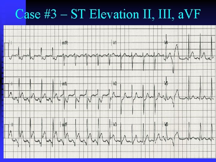 Case #3 – ST Elevation II, III, a. VF Case #3 – ST Elevation II, III, a. VF