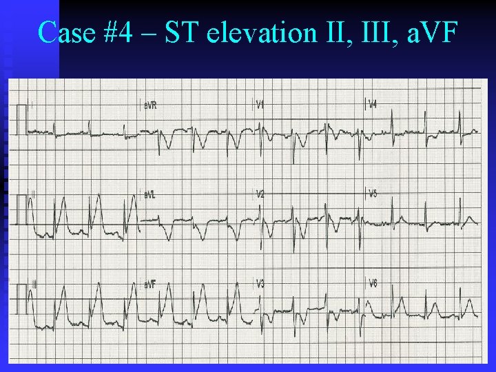 Case #4 – ST elevation II, III, a. VF Case #4 – ST elevation II, III, a. VF