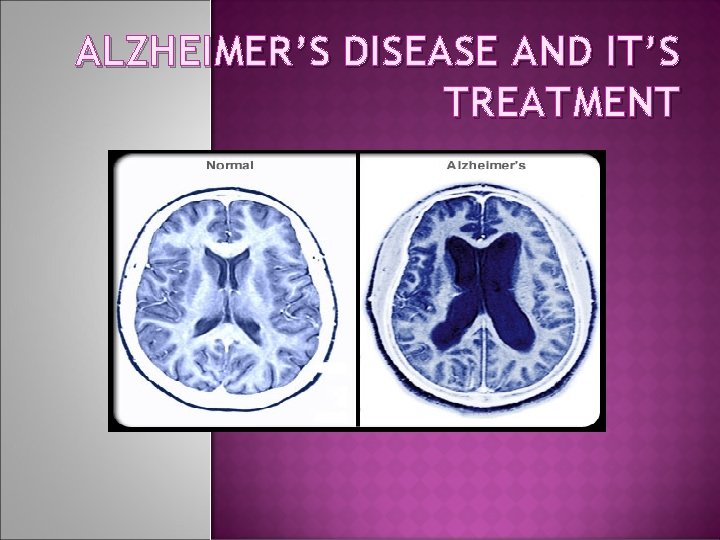 ALZHEIMER’S DISEASE AND IT’S TREATMENT 