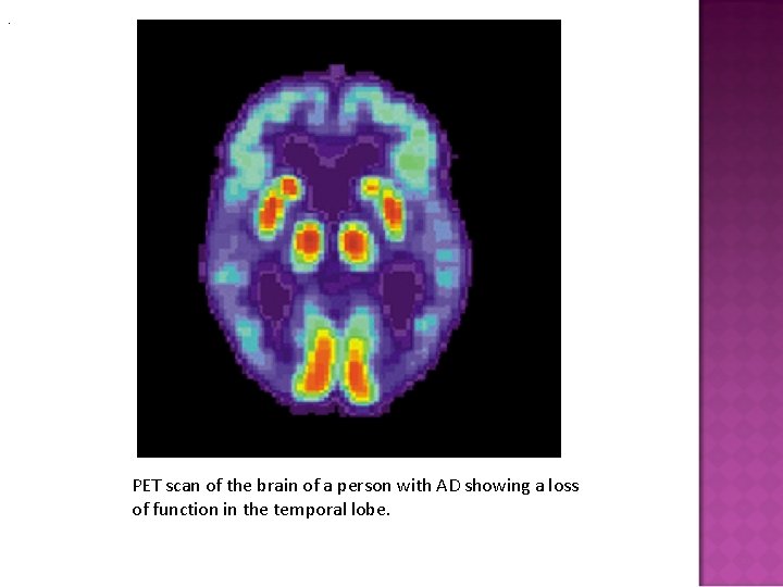 . PET scan of the brain of a person with AD showing a loss