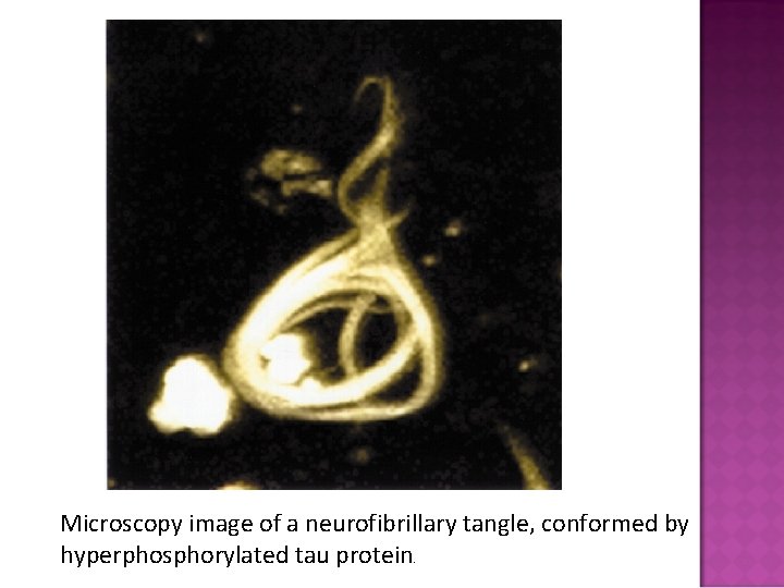 Microscopy image of a neurofibrillary tangle, conformed by hyperphosphorylated tau protein. 