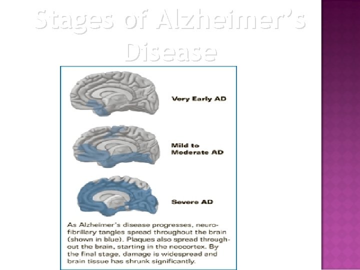 Stages of Alzheimer’s Disease 