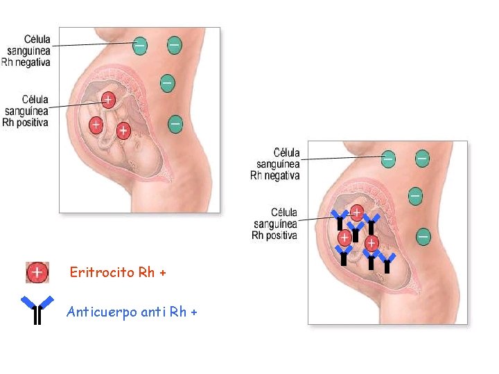 Eritrocito Rh + Anticuerpo anti Rh + 