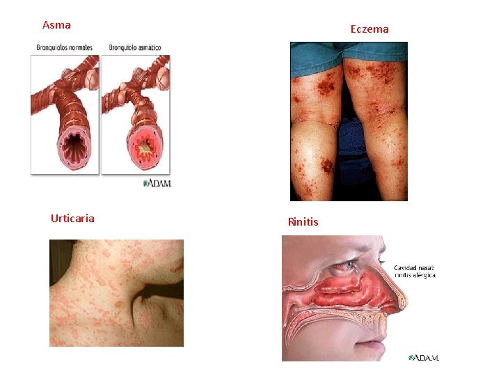 Asma Urticaria Eczema Rinitis 