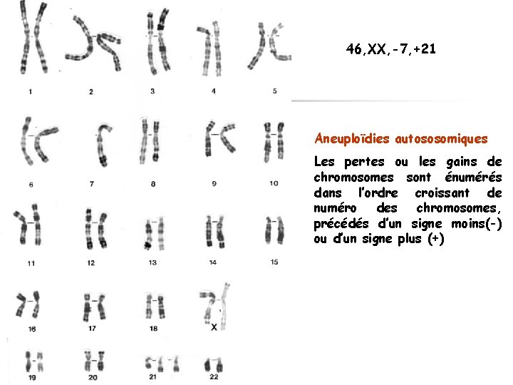 46, XX, -7, +21 Aneuploïdies autososomiques Les pertes ou les gains de chromosomes sont