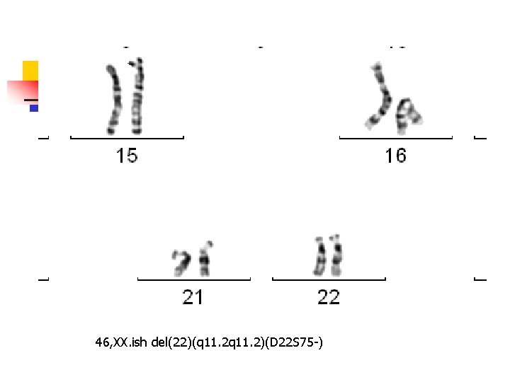 46, XX. ish del(22)(q 11. 2)(D 22 S 75 -) 